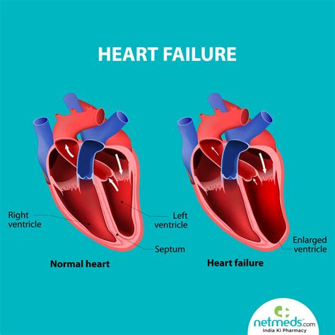 lv meaning medical|what is severe Lv impairment.